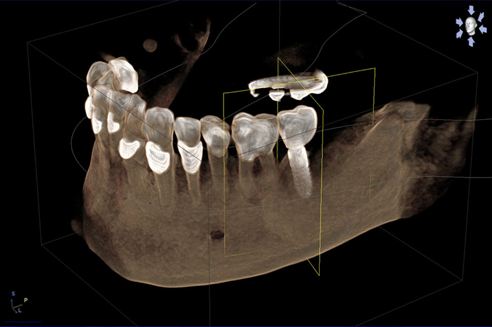 3D-geführte Implantation